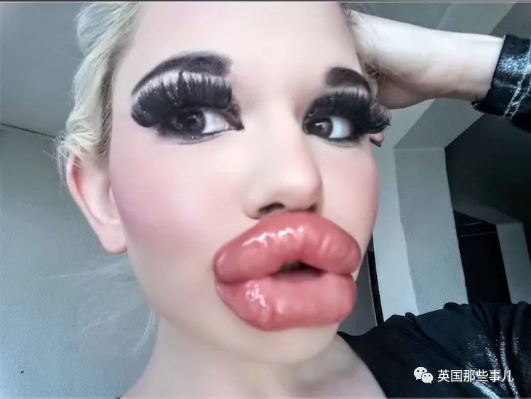 27次手术丰唇,女子疯狂整容100次成芭比疯狂丰唇