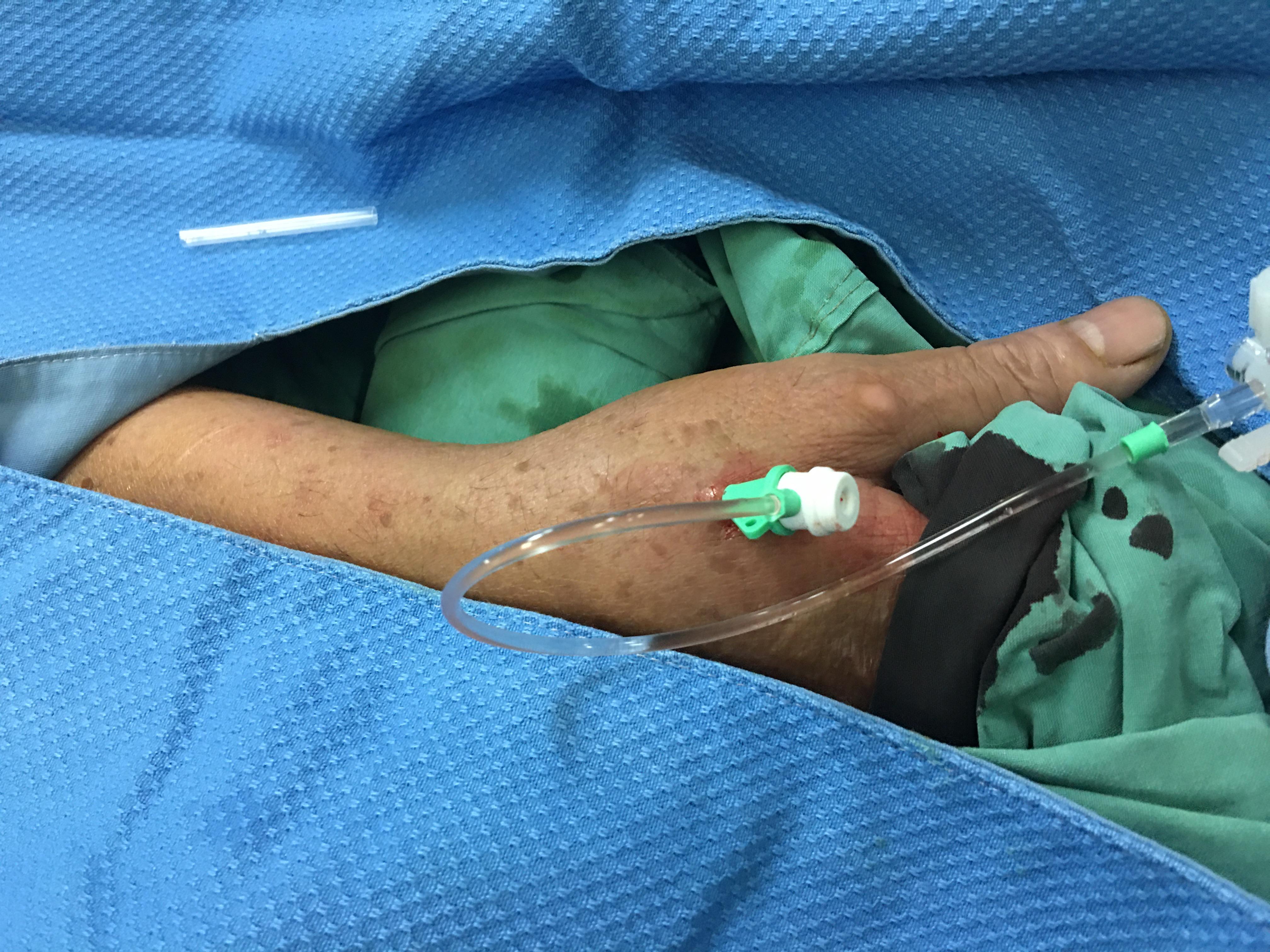 介入手术路径,介入手术临床路径