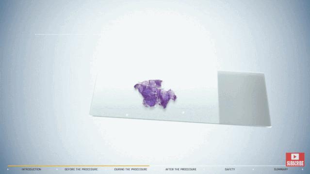 盘点医院各大科室侵入性检查:穿刺、内镜各显神通,小活检标本以“小”见“大”