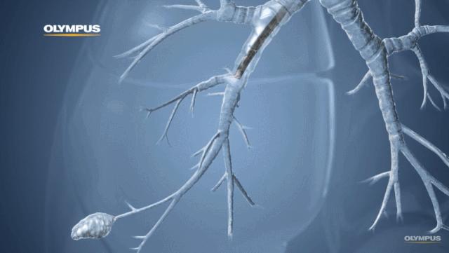 盘点医院各大科室侵入性检查:穿刺、内镜各显神通,小活检标本以“小”见“大”