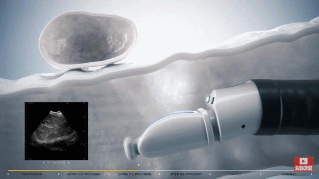 盘点医院各大科室侵入性检查:穿刺、内镜各显神通,小活检标本以“小”见“大”