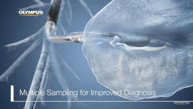 盘点医院各大科室侵入性检查:穿刺、内镜各显神通,小活检标本以“小”见“大”