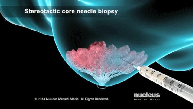 盘点医院各大科室侵入性检查:穿刺、内镜各显神通,小活检标本以“小”见“大”