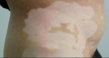 刚发现身上有两处白斑好治吗,身上出现小白斑怎么治疗