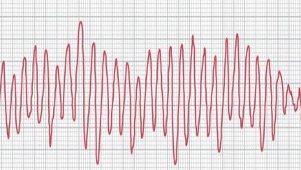 12岁阿奇霉素吃了6天怎么办,儿童阿奇霉素吃了7天危害