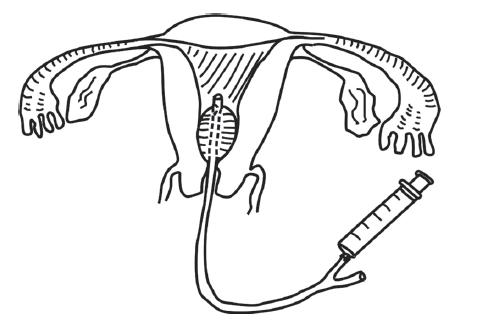 输卵管通液术手术配合,宫腔镜下输卵管通液术