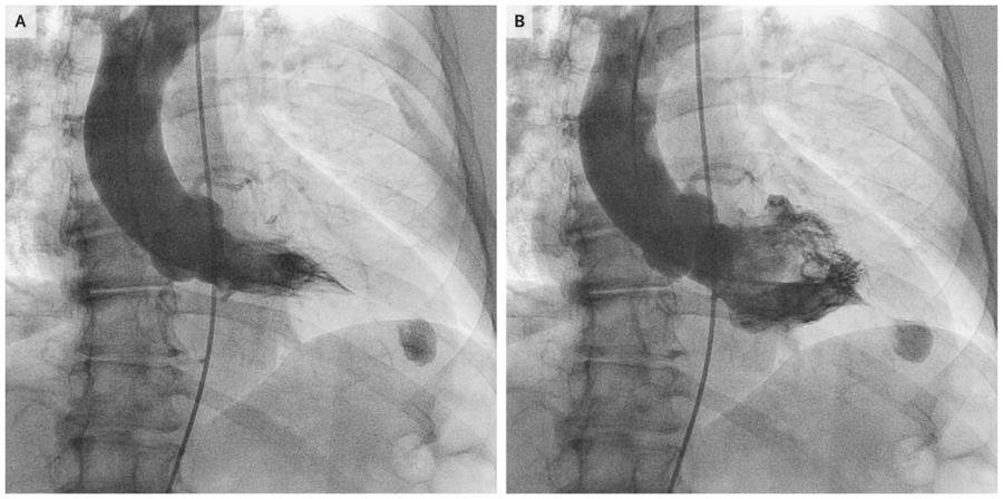 st-t改变一定就是心肌缺血吗,st-t改变是不是病理性心电图