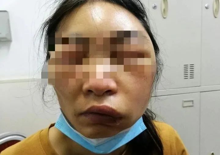 女子一觉醒来竟然毁容了,一觉醒来脸肿得很严重