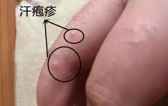 湿疹汗疱疹要注意什么,夏季皮肤湿疹注意事项