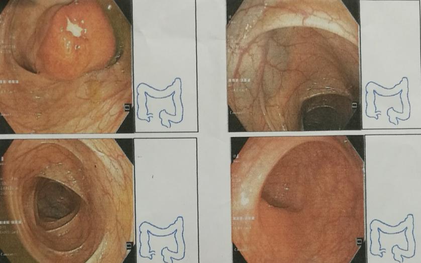 有一种口腔溃疡叫白塞病,反复口腔溃疡已经20年是白塞病吗