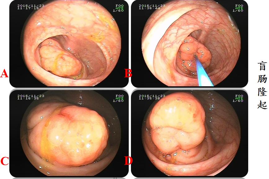 有一种口腔溃疡叫白塞病,反复口腔溃疡已经20年是白塞病吗
