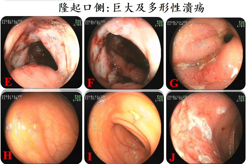 有一种口腔溃疡叫白塞病,反复口腔溃疡已经20年是白塞病吗