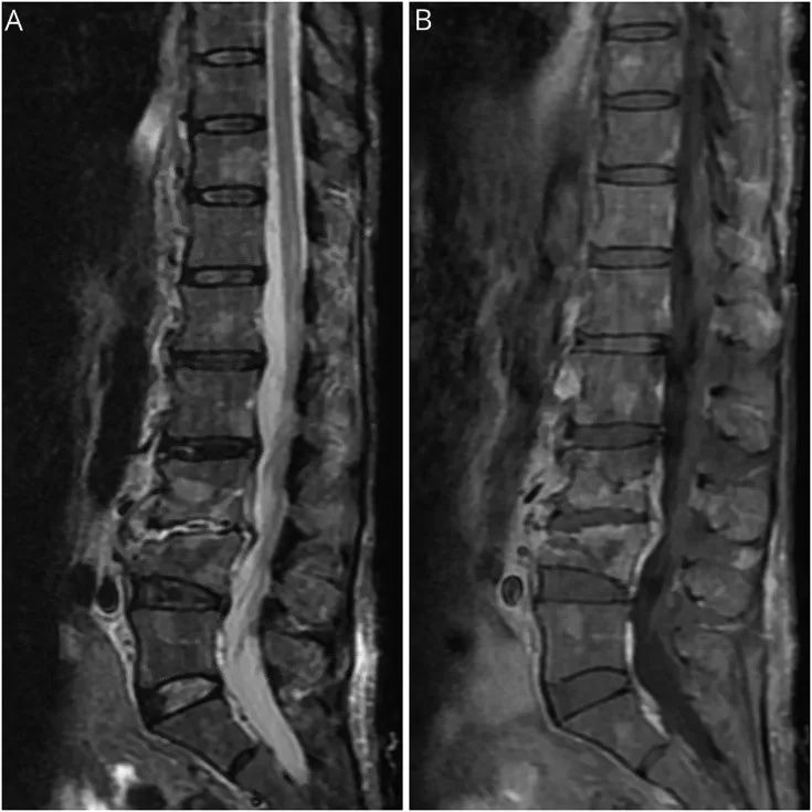 从定位到定性，层层揭秘59岁多发性骨髓瘤患者为何出现下肢无力和麻木？丨临床推理