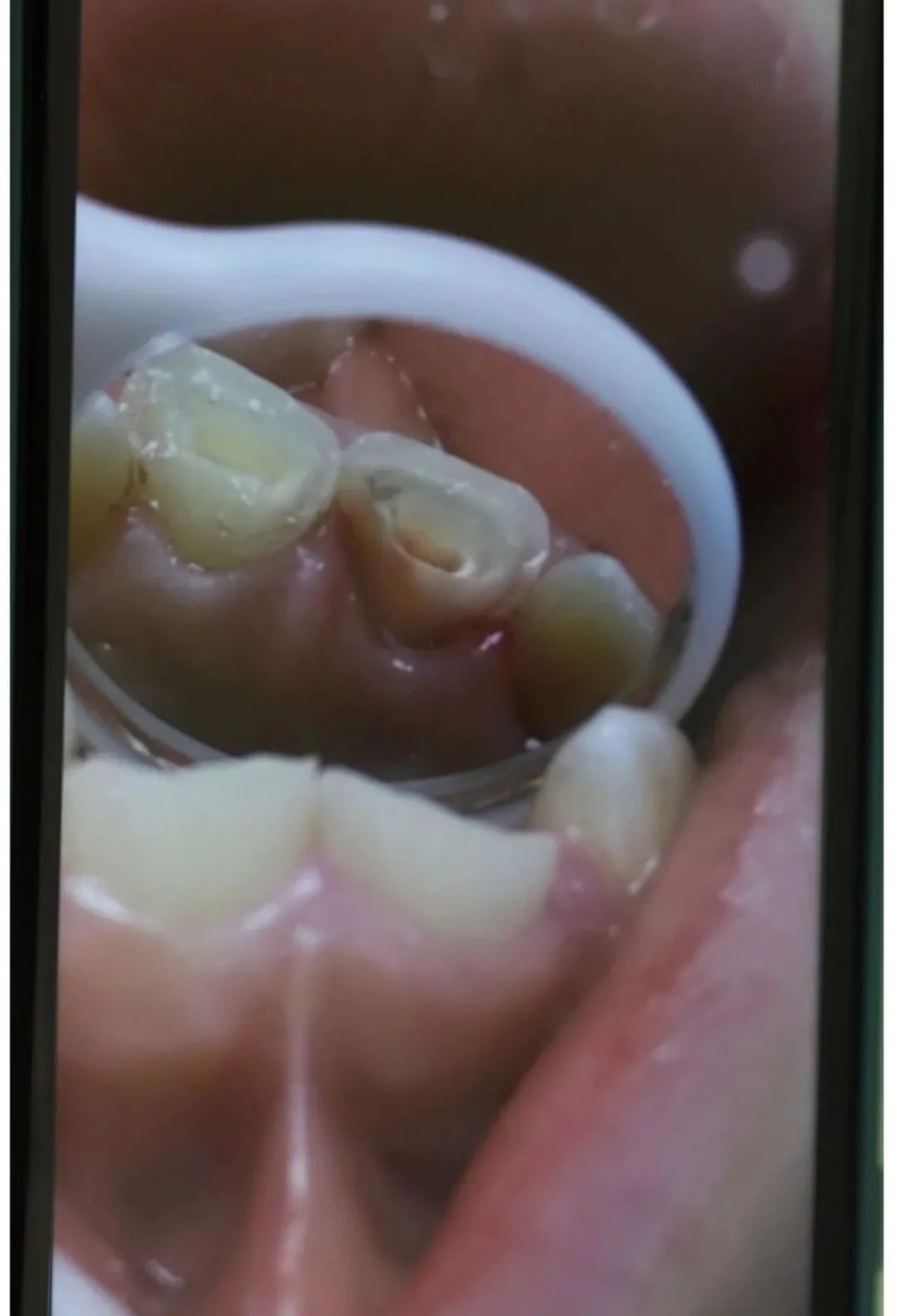 一岁小孩磕断两颗门牙有啥说法吗,两小孩无意碰撞牙齿磕断