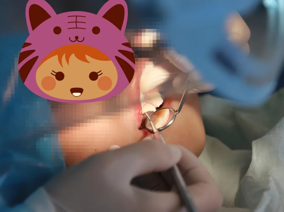 一岁小孩磕断两颗门牙有啥说法吗,两小孩无意碰撞牙齿磕断