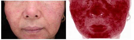 最近的脸又痒、又红、还发烫,华西专家说,你多半是遭了敏感性皮肤了!