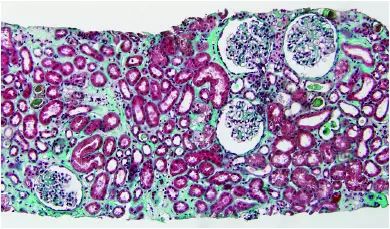 胆汁管型肾病,你听说过吗?