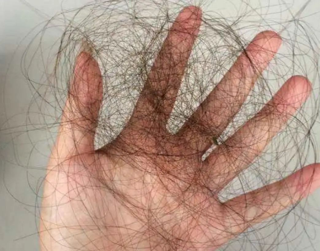 转！广西数十万人关注的爱发活动，助你远离脱发秃顶困扰