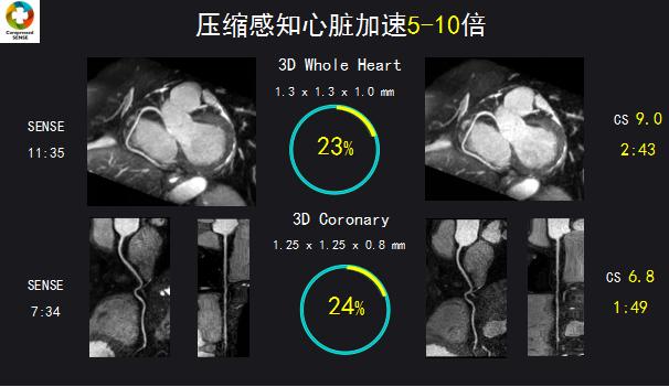 压缩时间、感知精华——西北首台3.0T光速科研型磁共振在我院投入运行