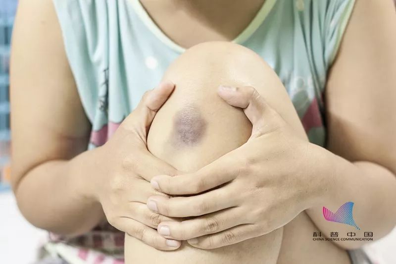 新生宝宝为啥屁股上有胎记,新生儿宝宝屁股淤青是怎么回事