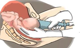 免去“一刀之苦”！阴道助产，是怎么一回事？