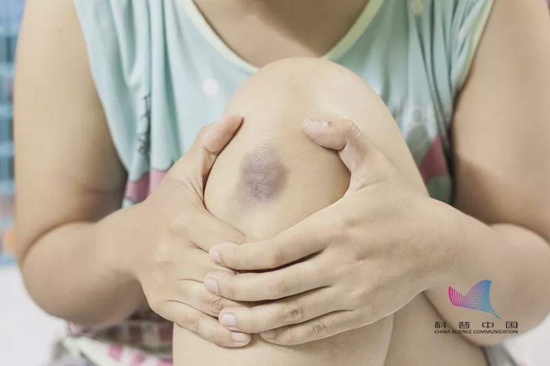 为什么宝宝屁股有一块淤青斑,为什么新生婴儿屁股会有大块淤青