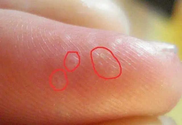 注意｜手上长水泡瘙痒难消？医生提醒：这症状夏天高发