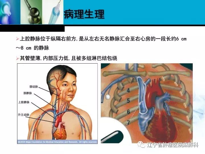肺癌晚期上腔静脉综合征,上腔静脉综合征排期