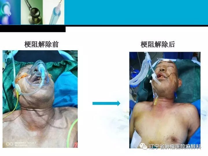 肺癌晚期上腔静脉综合征,上腔静脉综合征排期