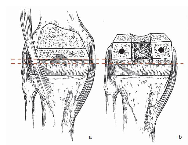 膝关节置换单膝和全膝,全膝关节置换能跪吗
