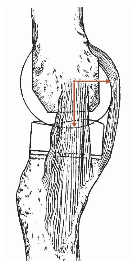 膝关节置换单膝和全膝,全膝关节置换能跪吗