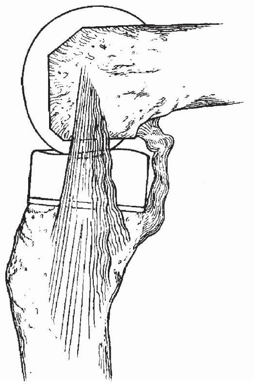 膝关节置换单膝和全膝,全膝关节置换能跪吗