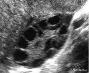 27岁月经乱了FSH两次升高，我卵巢早衰了吗？