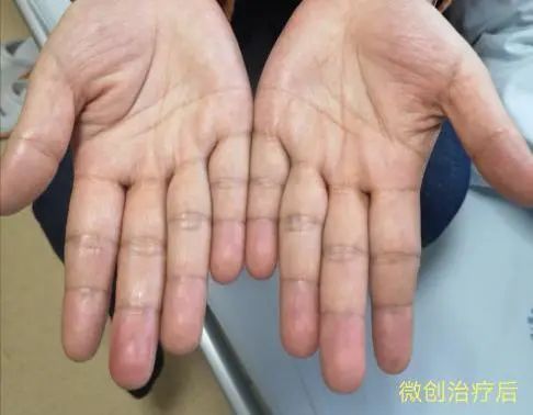 她为这病自卑了20多年，没想到神奇的两根针一扎，治好了