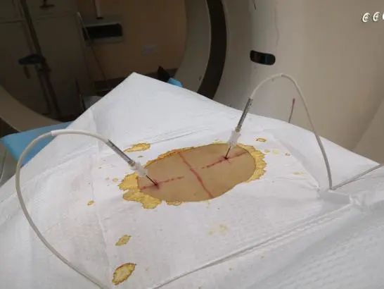 她为这病自卑了20多年，没想到神奇的两根针一扎，治好了