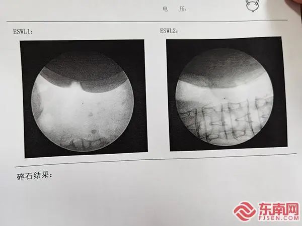 碎石神器！宁德市中医院引进国内新款大型双定位体外碎石机