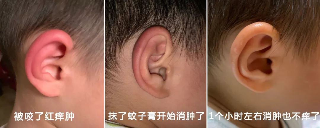 教你2分钟快速止痒,一小瓶止痒的药膏