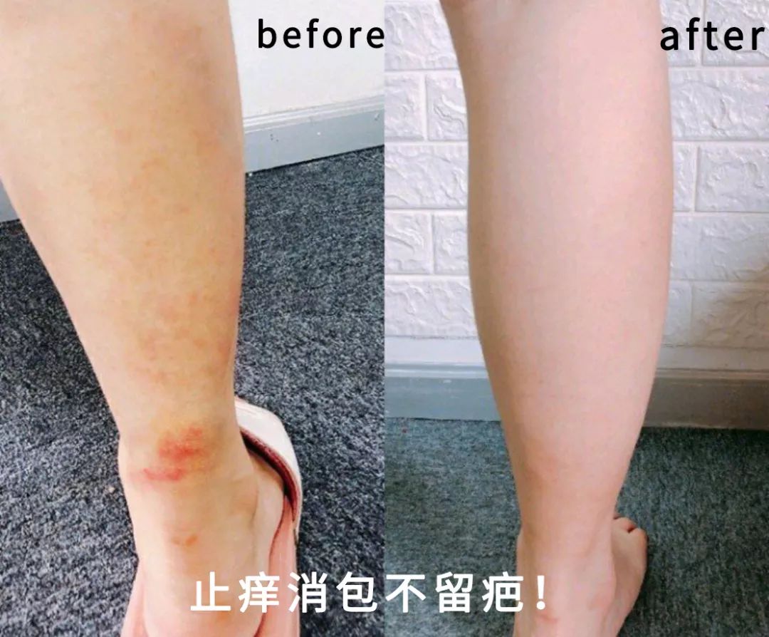 教你2分钟快速止痒,一小瓶止痒的药膏