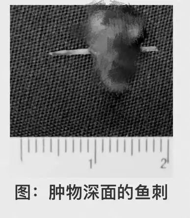 女子十只手指肿查出患癌,五旬大妈体检查出肺癌