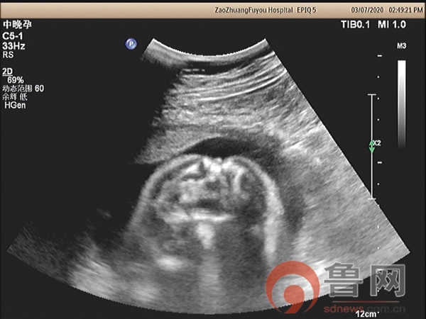 枣庄市妇幼保健院超声科诊断出一例胎儿开放性脊柱裂