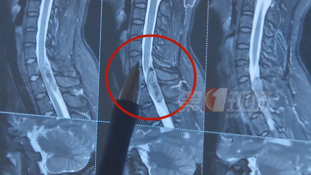 石家庄再增一处施工路段！分段断交！公交绕行！|女白领脖子酸痛做了这个动作，9小时后竟瘫痪了