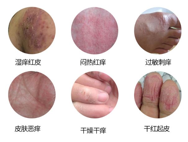 皮炎湿疹抹凡士林能抹多久,湿疹足癣用什么药膏最有效