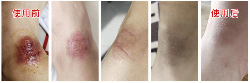 皮炎湿疹抹凡士林能抹多久,湿疹足癣用什么药膏最有效