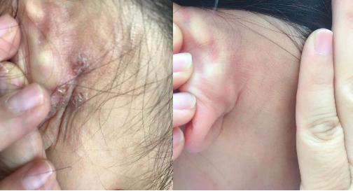 皮炎湿疹抹凡士林能抹多久,湿疹足癣用什么药膏最有效