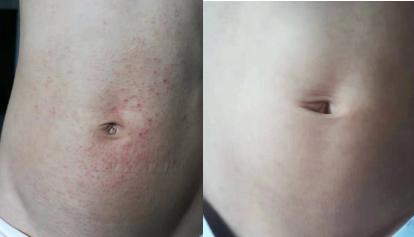 皮炎湿疹抹凡士林能抹多久,湿疹足癣用什么药膏最有效