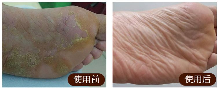 皮炎湿疹抹凡士林能抹多久,湿疹足癣用什么药膏最有效