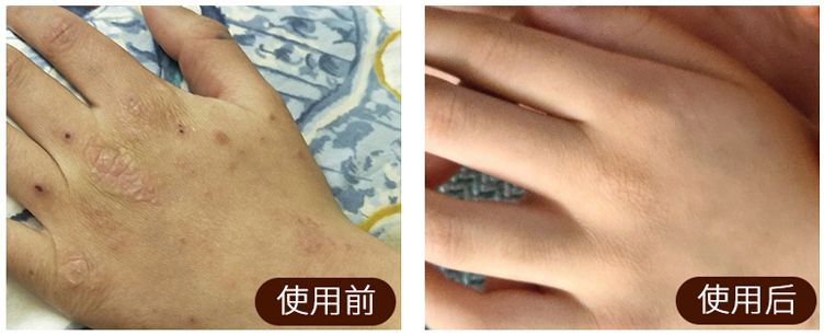 皮炎湿疹抹凡士林能抹多久,湿疹足癣用什么药膏最有效