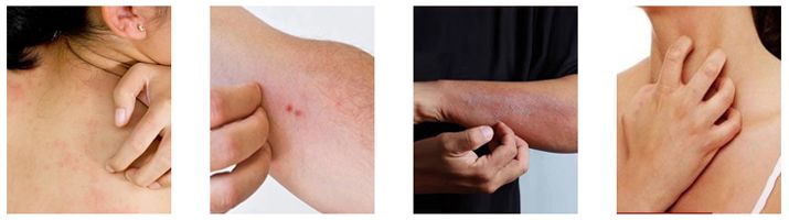 皮炎湿疹抹凡士林能抹多久,湿疹足癣用什么药膏最有效