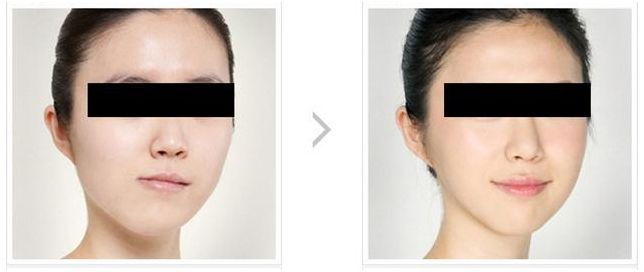 矫正牙齿有年龄限制吗,矫正牙齿的最好年龄是多少岁