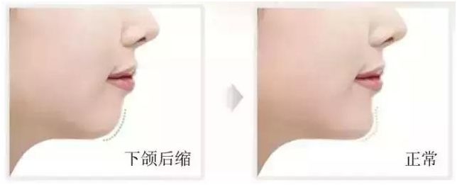 矫正牙齿有年龄限制吗,矫正牙齿的最好年龄是多少岁